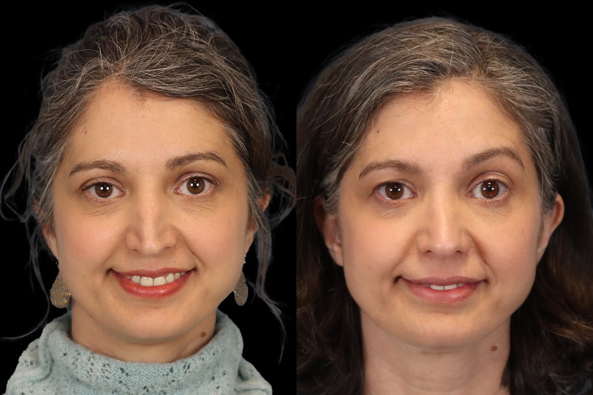 Rhinoplasty Before & After Gallery - Patient 140196 - Image 2