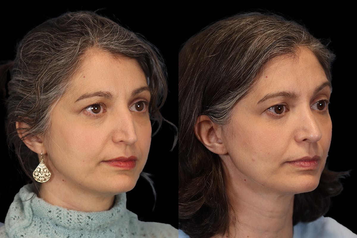 Rhinoplasty Before & After Gallery - Patient 140196 - Image 3