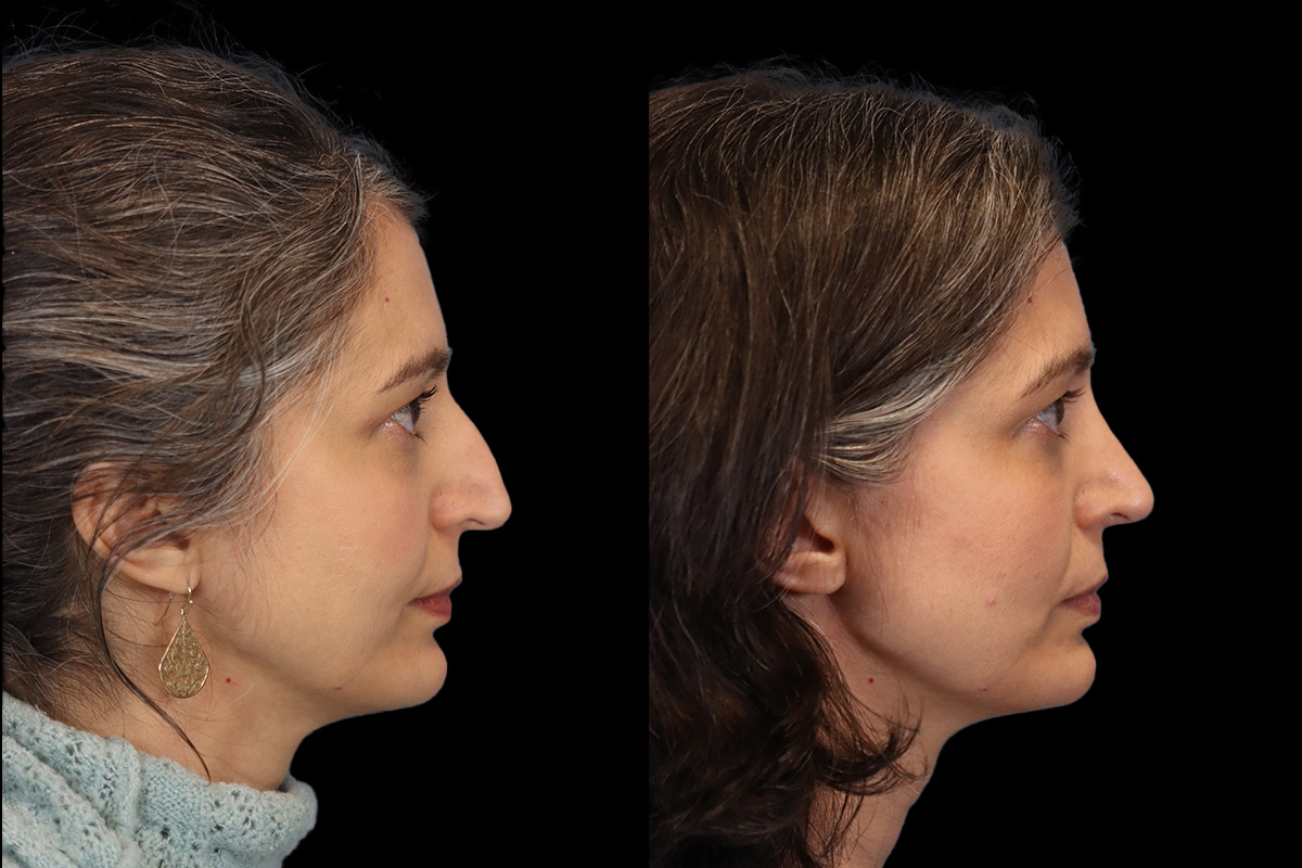 Nose Before & After Gallery - Patient 260710 - Image 4