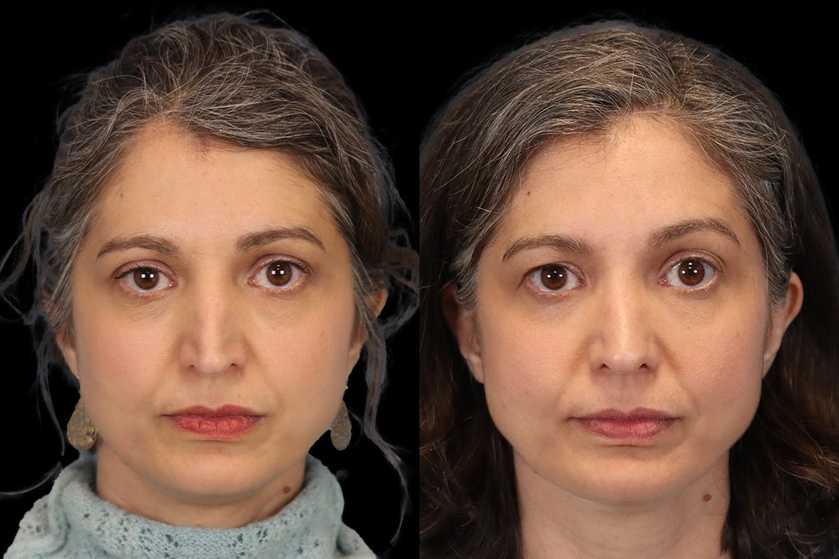 Rhinoplasty Before & After Gallery - Patient 140196 - Image 1