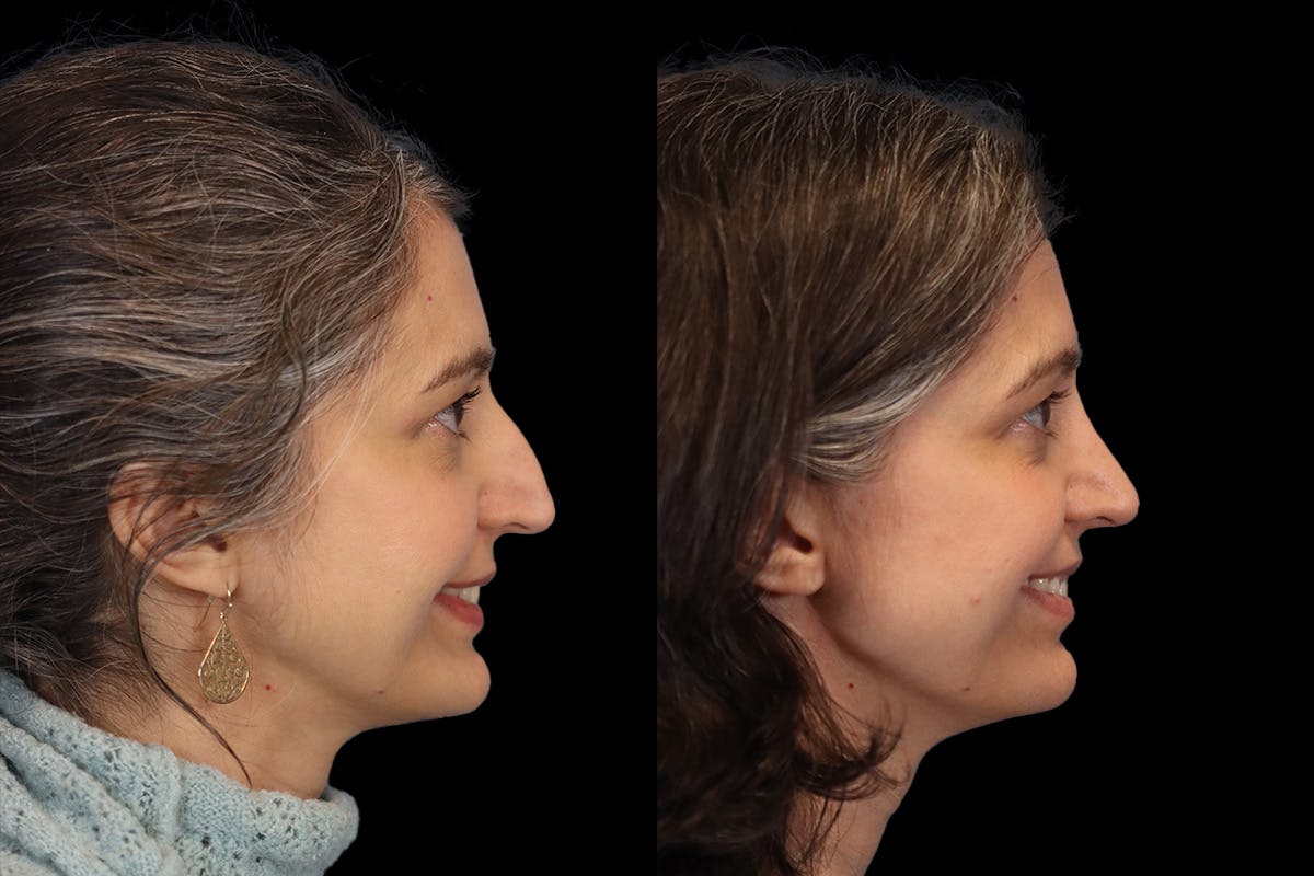 Rhinoplasty Before & After Gallery - Patient 140196 - Image 5
