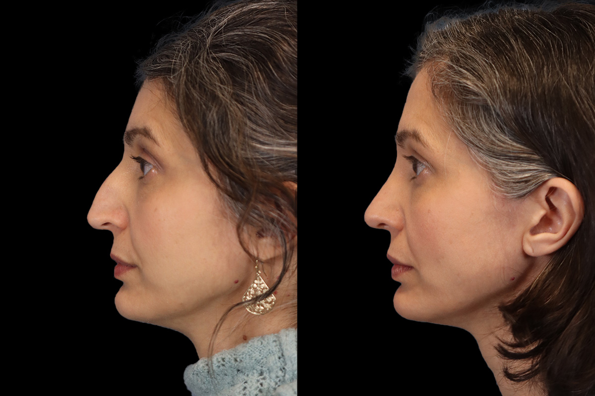 Nose Before & After Gallery - Patient 260710 - Image 7