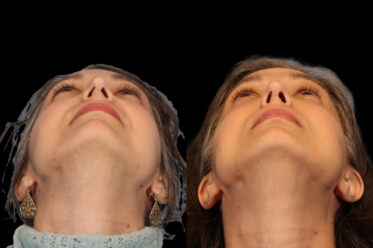 Nose Before & After Gallery - Patient 260710 - Image 9