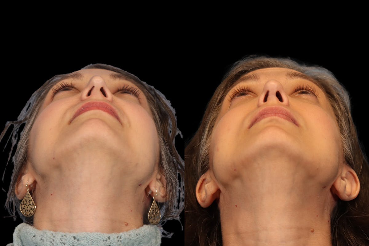 Rhinoplasty Before & After Gallery - Patient 140196 - Image 10