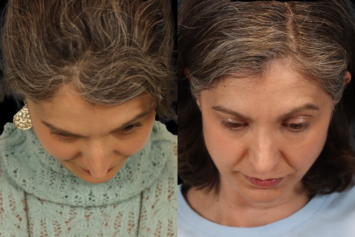 Rhinoplasty Before & After Gallery - Patient 140196 - Image 9