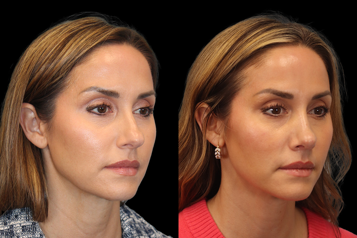 Nose Before & After Gallery - Patient 338757 - Image 2