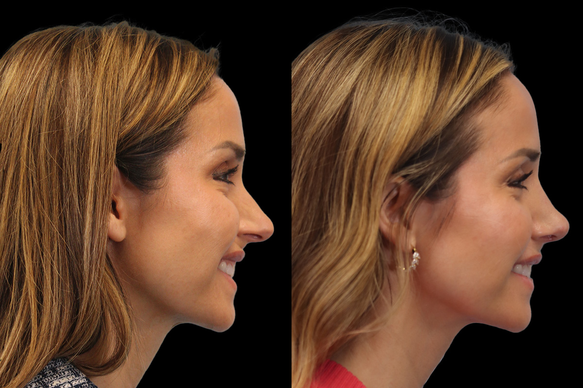 Nose Before & After Gallery - Patient 338757 - Image 4