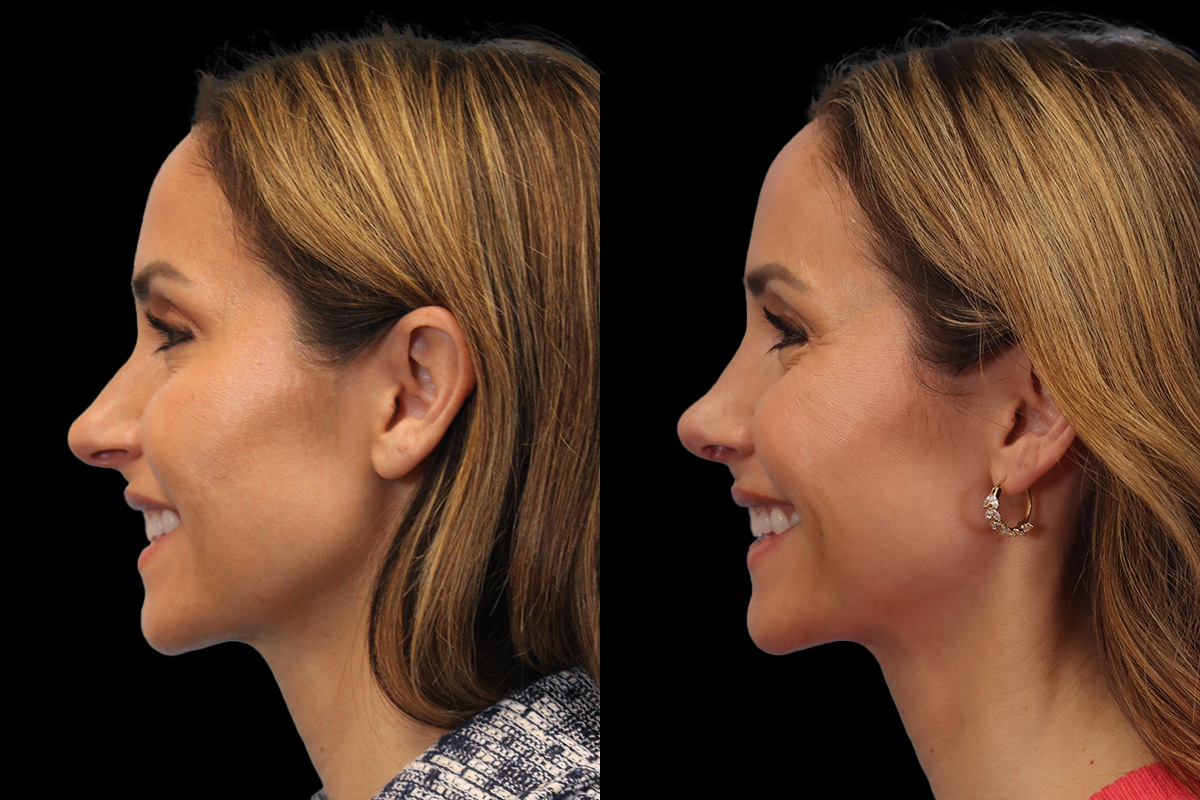 Nose Before & After Gallery - Patient 338757 - Image 7