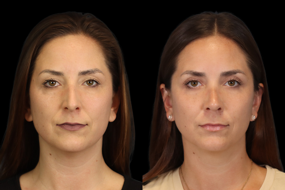 Rhinoplasty Before & After Gallery - Patient 244840 - Image 1