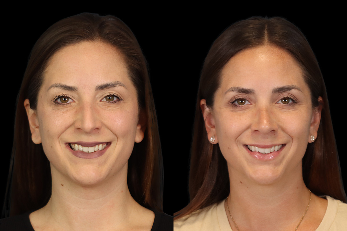 Nose Before & After Gallery - Patient 264420 - Image 2