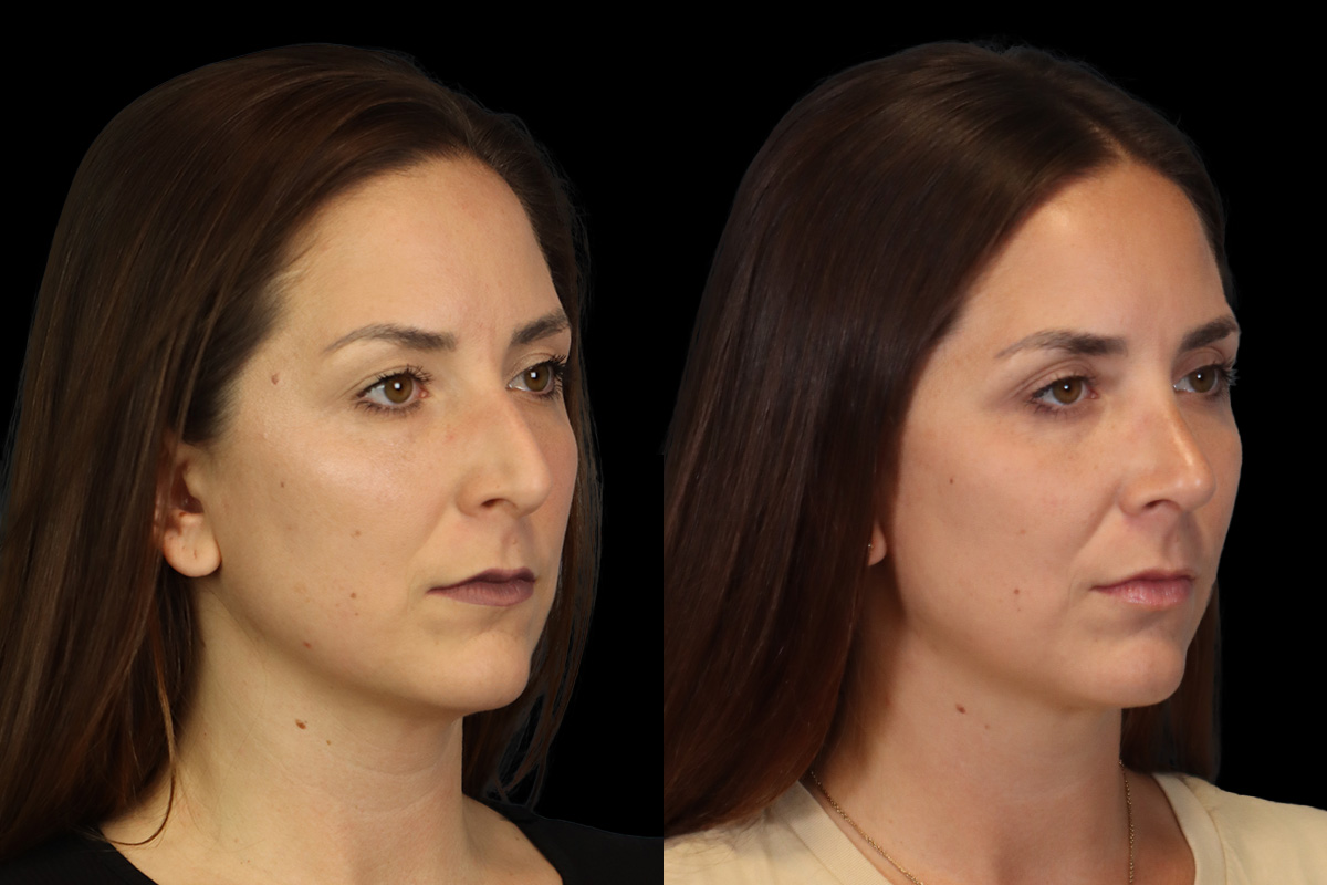 Nose Before & After Gallery - Patient 264420 - Image 3