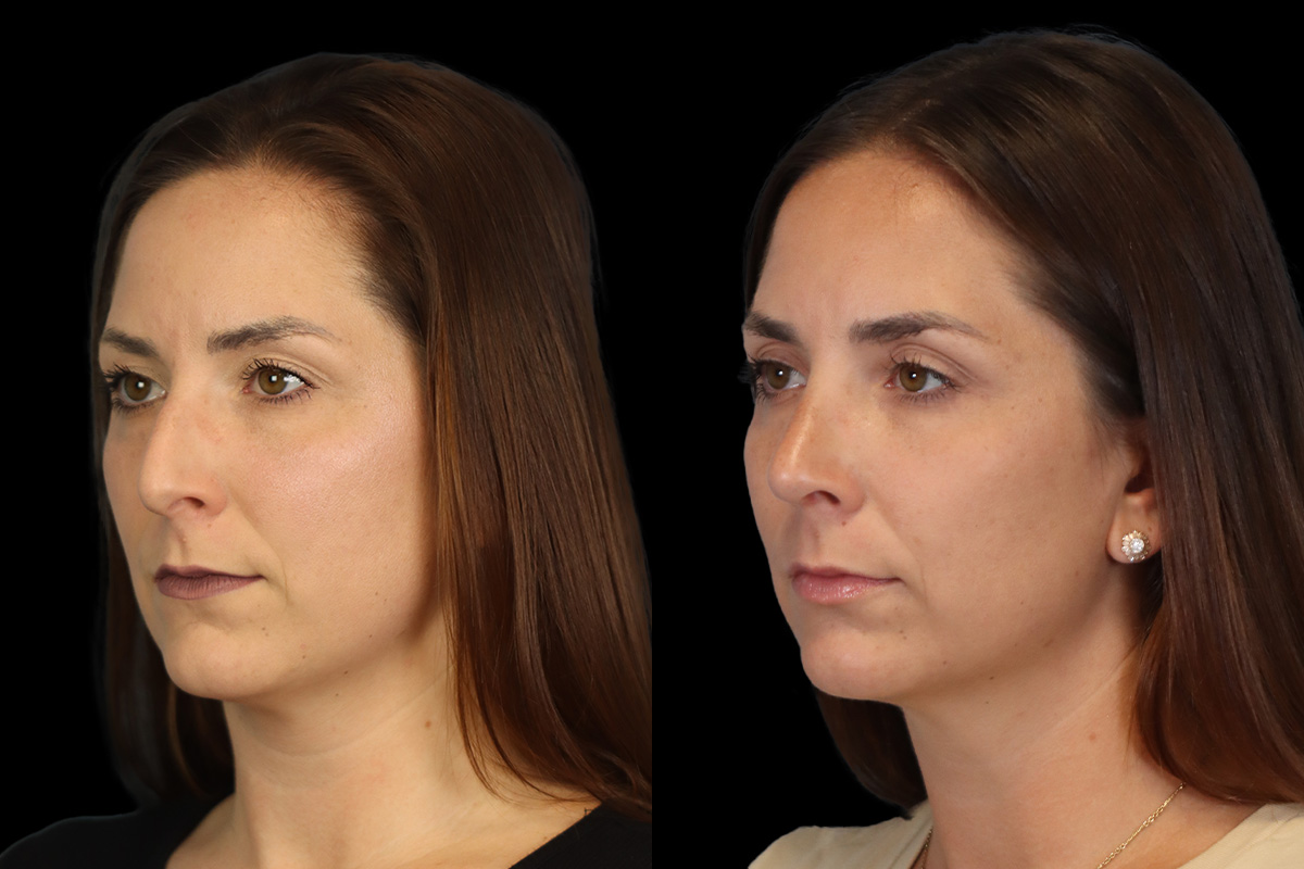 Nose Before & After Gallery - Patient 264420 - Image 6