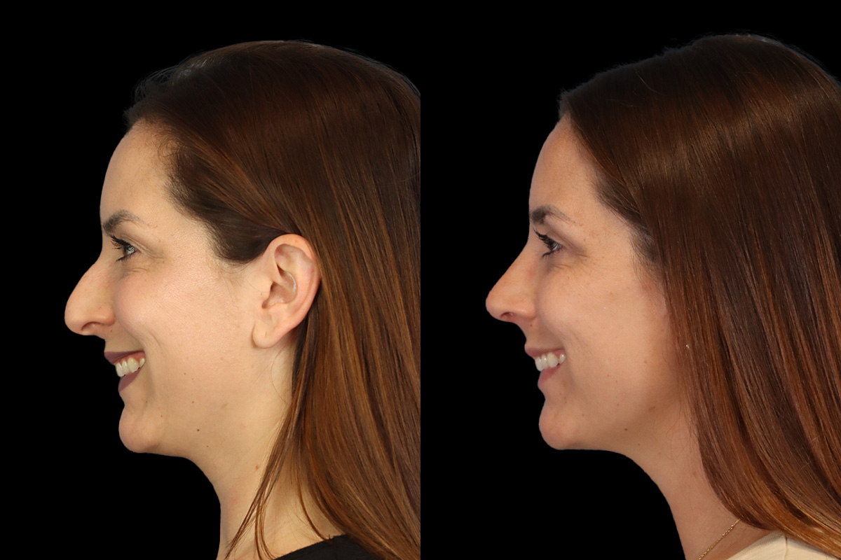 Nose Before & After Gallery - Patient 264420 - Image 8