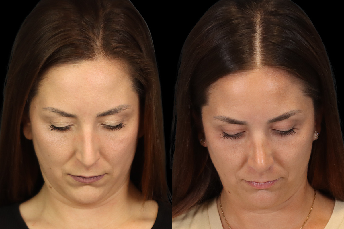 Nose Before & After Gallery - Patient 264420 - Image 10