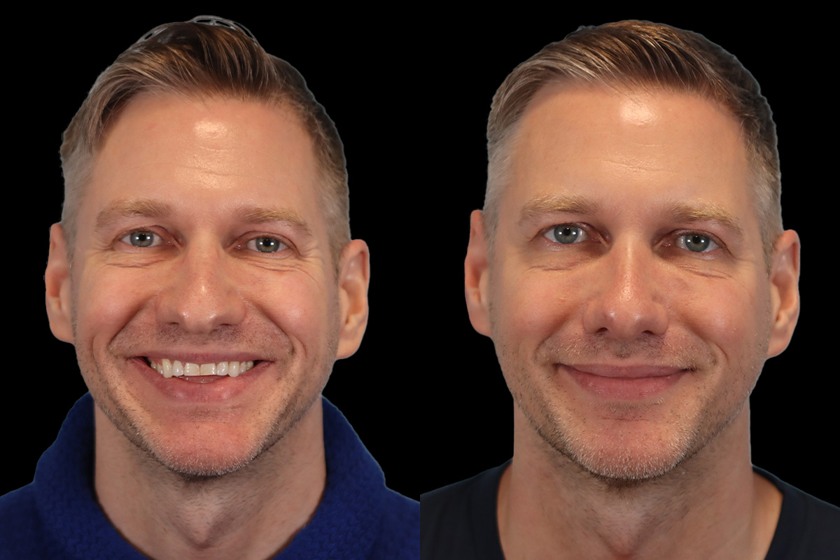 Nose Before & After Gallery - Patient 376590 - Image 2