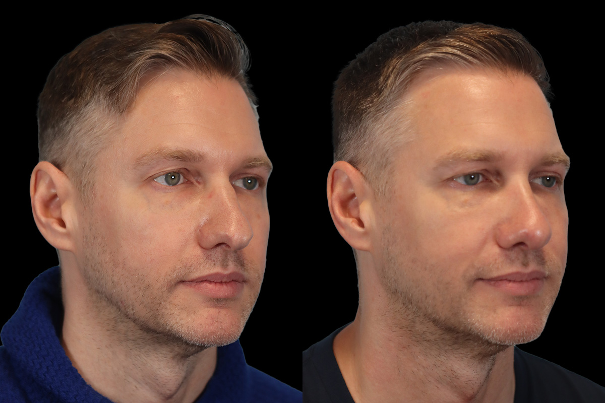 Nose Before & After Gallery - Patient 376590 - Image 3