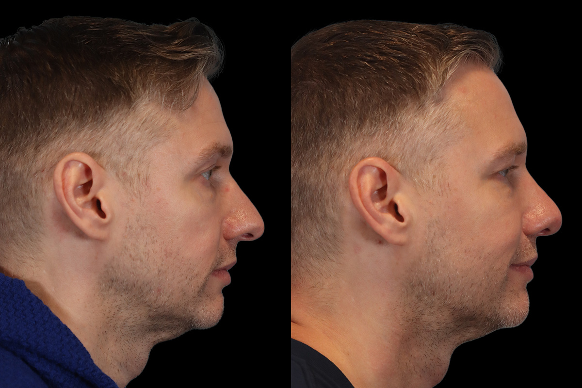 Nose Before & After Gallery - Patient 376590 - Image 4