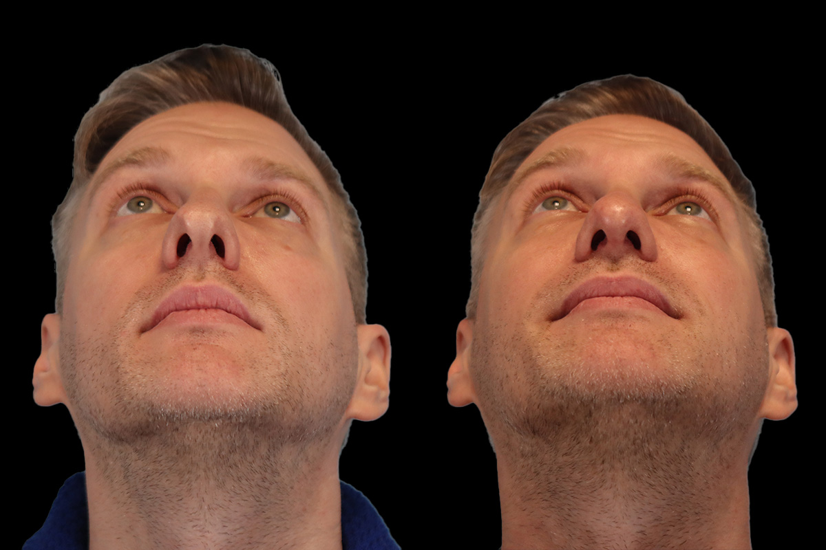 Nose Before & After Gallery - Patient 376590 - Image 7