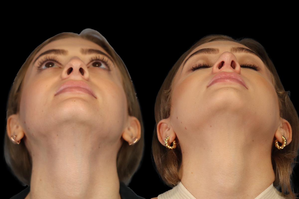 Nose Before & After Gallery - Patient 381806 - Image 10