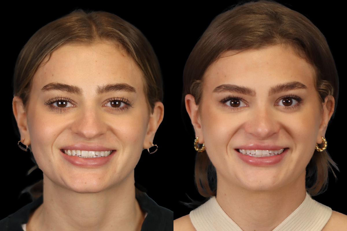 Nose Before & After Gallery - Patient 381806 - Image 2