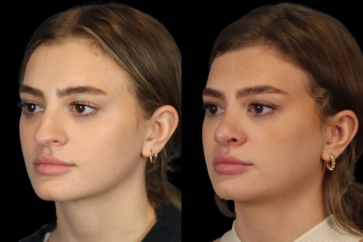 Nose Before & After Gallery - Patient 381806 - Image 6