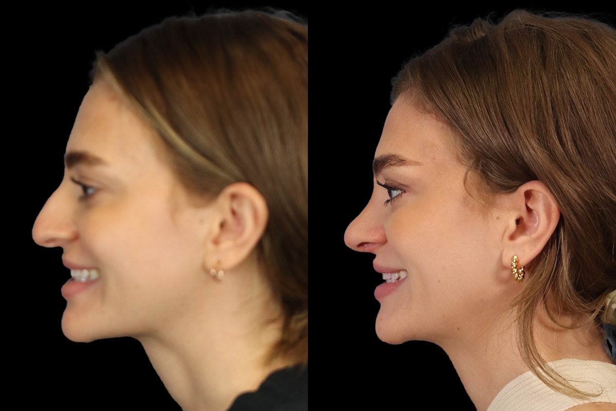 Nose Before & After Gallery - Patient 381806 - Image 8