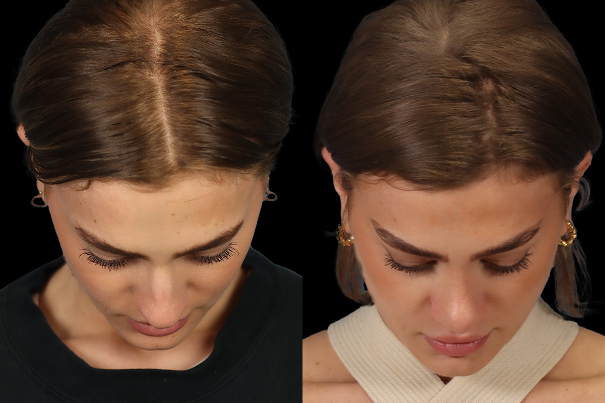 Nose Before & After Gallery - Patient 381806 - Image 9