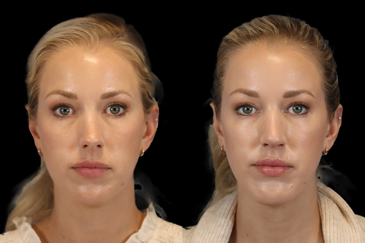 Rhinoplasty Before & After Gallery - Patient 190582 - Image 1