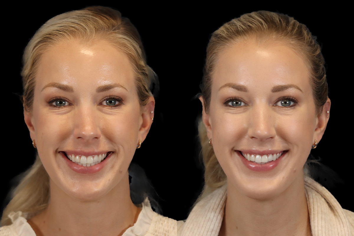 Rhinoplasty Before & After Gallery - Patient 190582 - Image 2