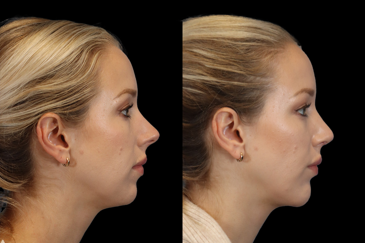 Rhinoplasty Before & After Gallery - Patient 190582 - Image 4