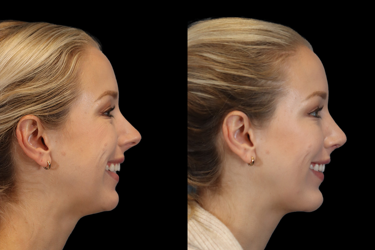 Rhinoplasty Before & After Gallery - Patient 190582 - Image 5