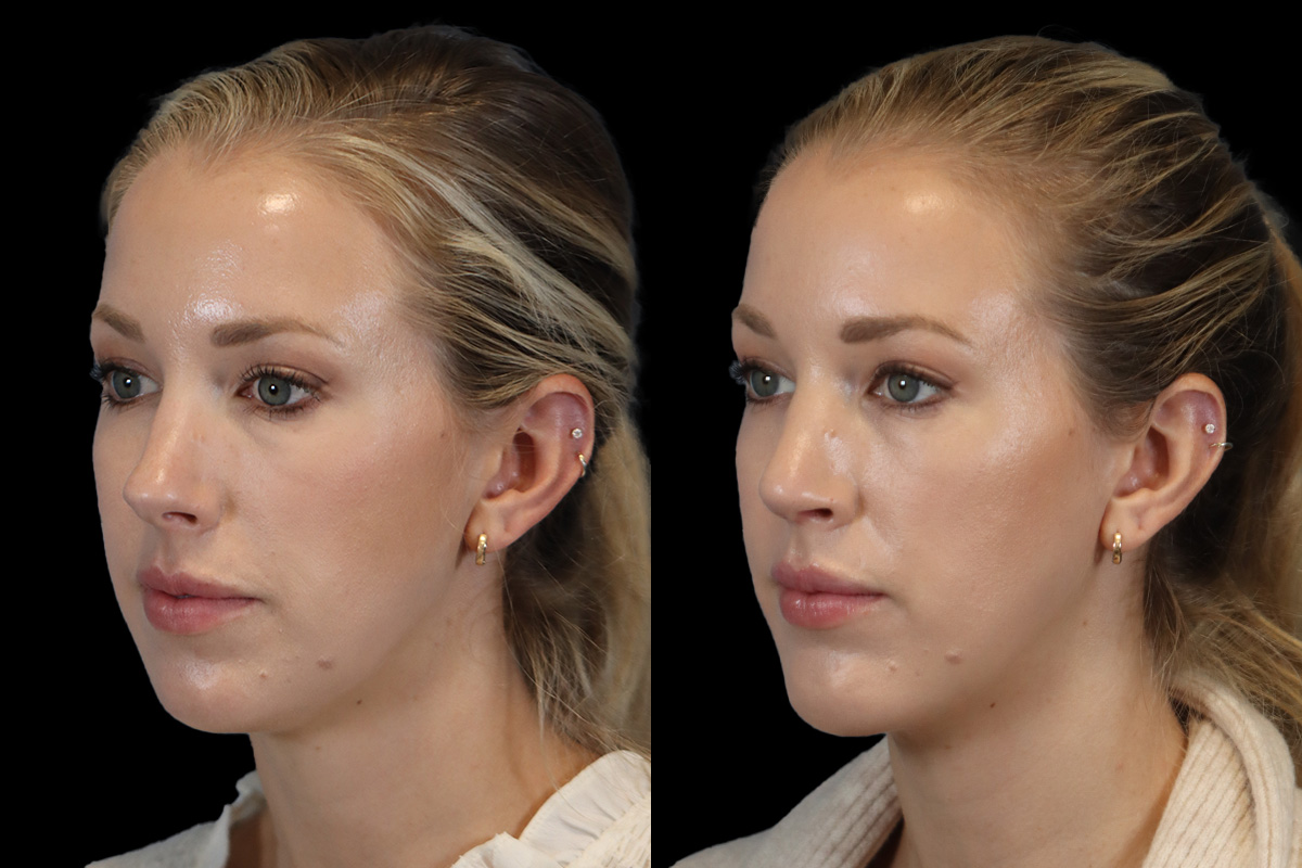 Rhinoplasty Before & After Gallery - Patient 190582 - Image 6