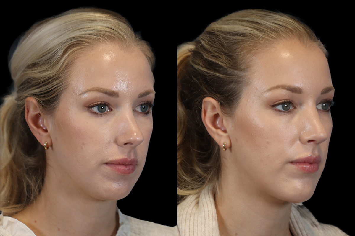 Rhinoplasty Before & After Gallery - Patient 190582 - Image 3