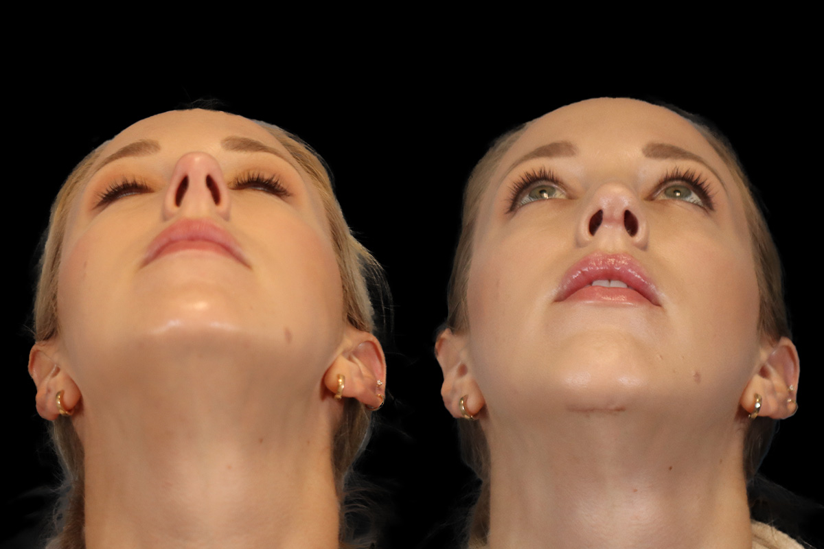 Rhinoplasty Before & After Gallery - Patient 190582 - Image 9