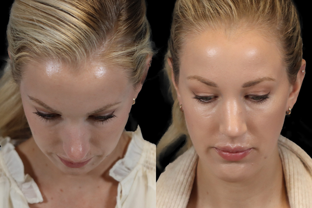 Rhinoplasty Before & After Gallery - Patient 190582 - Image 10