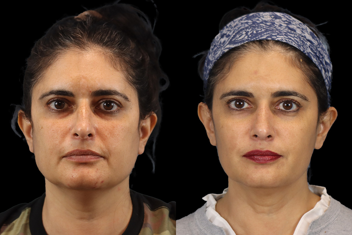 Rhinoplasty Before & After Gallery - Patient 284649 - Image 1