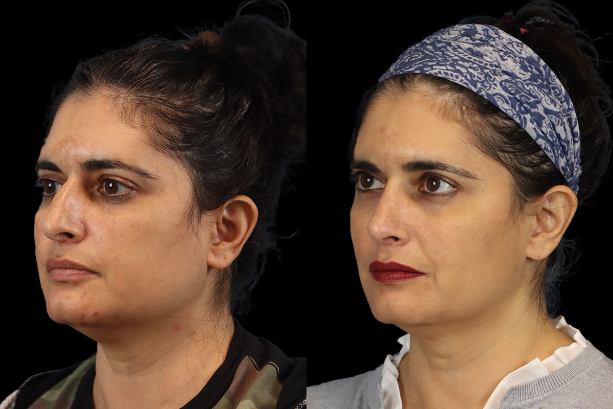 Nose Before & After Gallery - Patient 324154 - Image 4