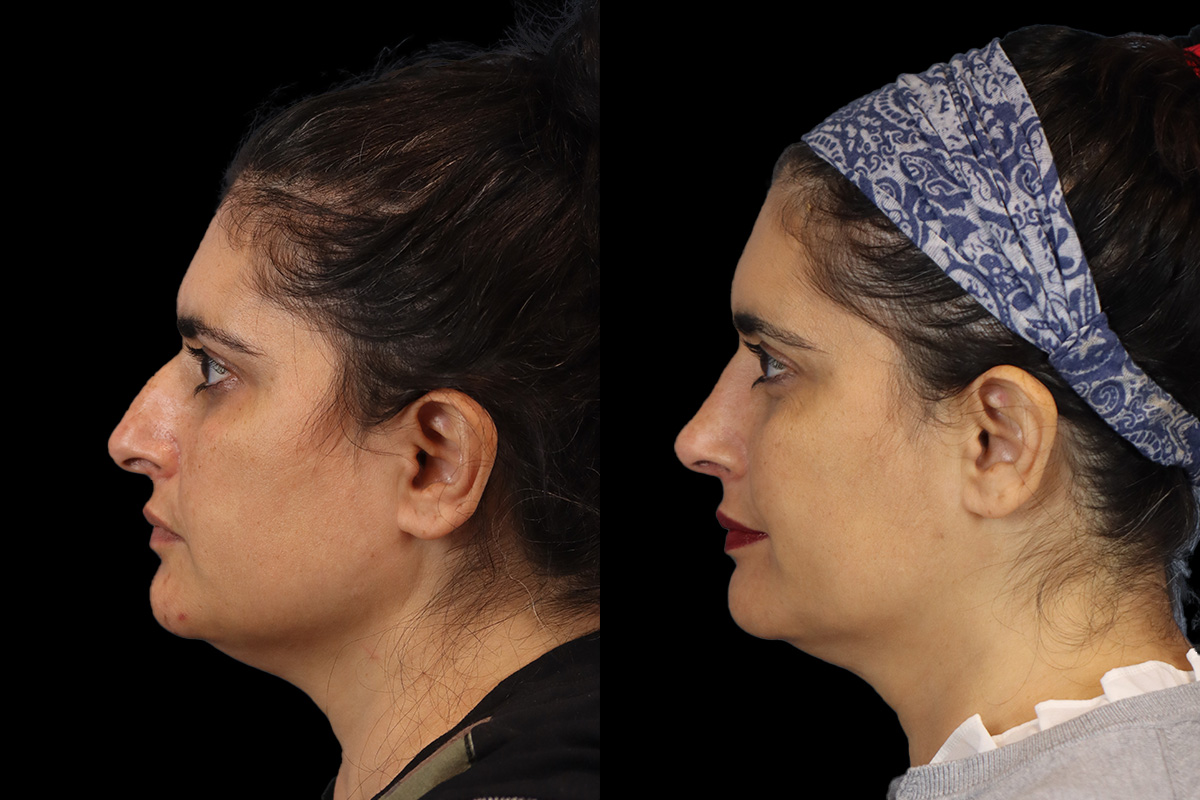 Nose Before & After Gallery - Patient 324154 - Image 6