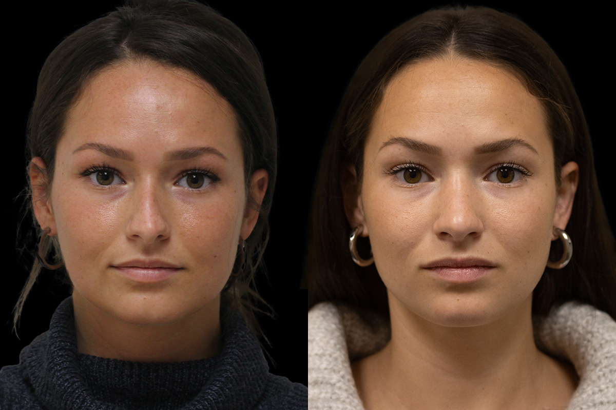 Rhinoplasty Before & After Gallery - Patient 386499 - Image 1