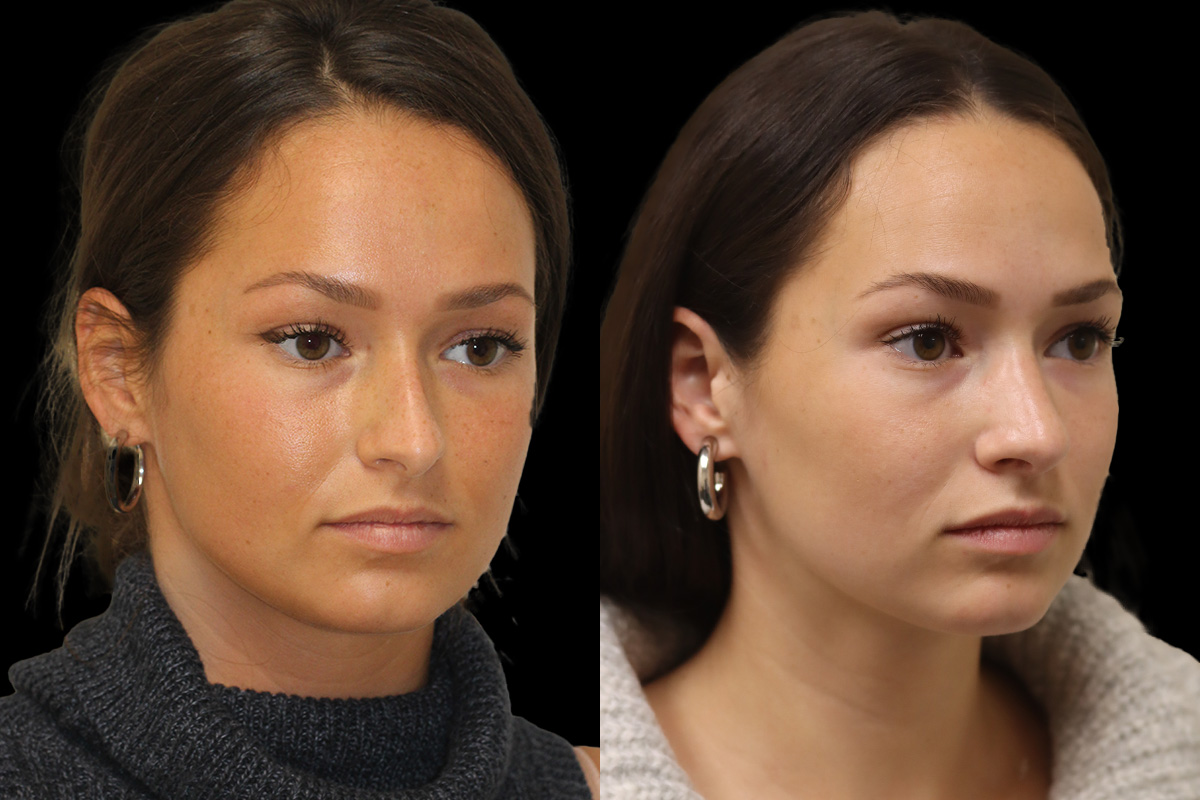 Rhinoplasty Before & After Gallery - Patient 386499 - Image 3
