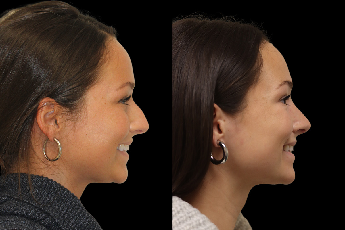 Rhinoplasty Before & After Gallery - Patient 386499 - Image 5