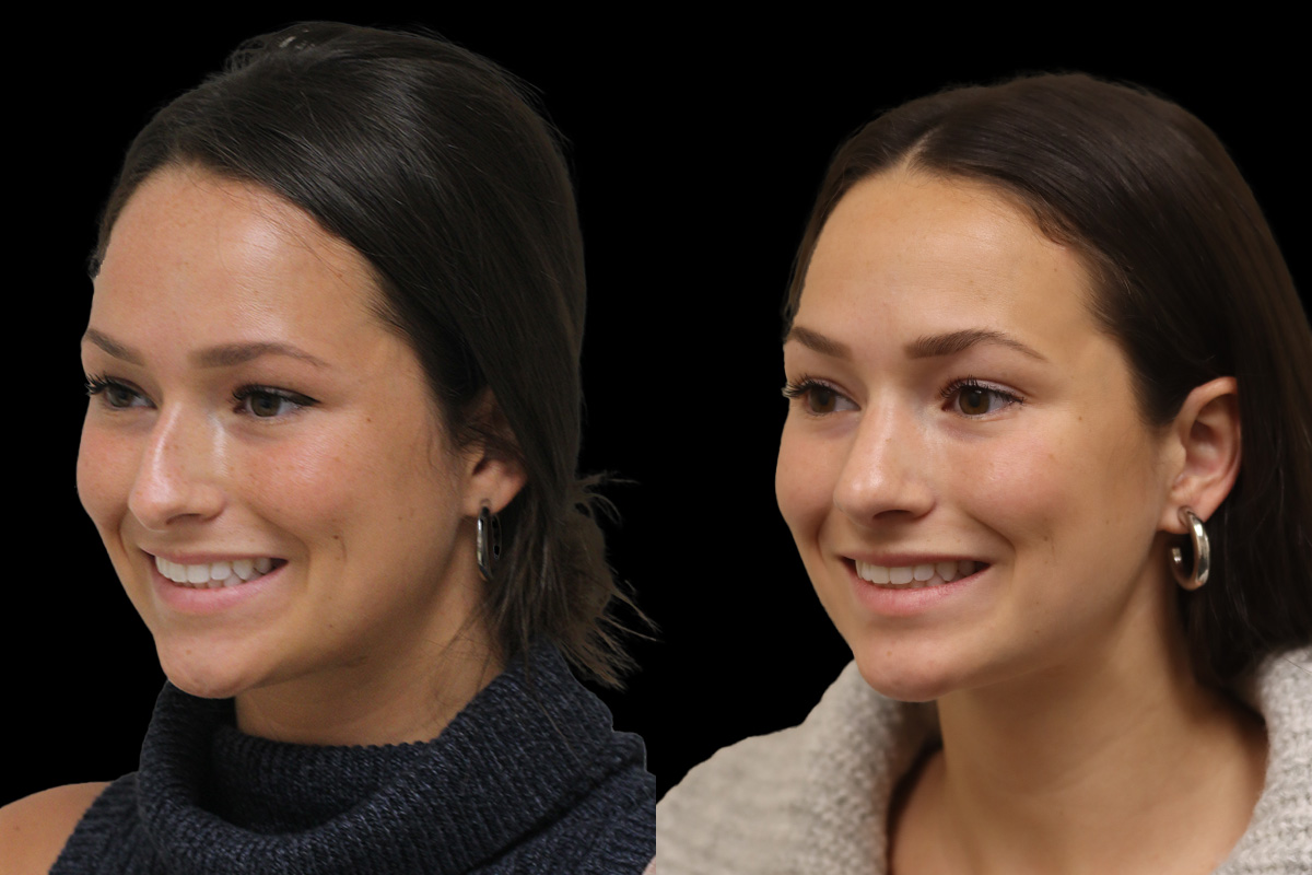 Rhinoplasty Before & After Gallery - Patient 386499 - Image 7