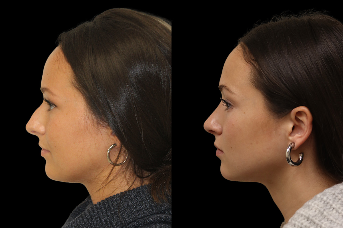 Rhinoplasty Before & After Gallery - Patient 386499 - Image 8