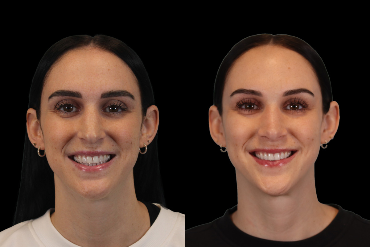 Nose Before & After Gallery - Patient 785538 - Image 2