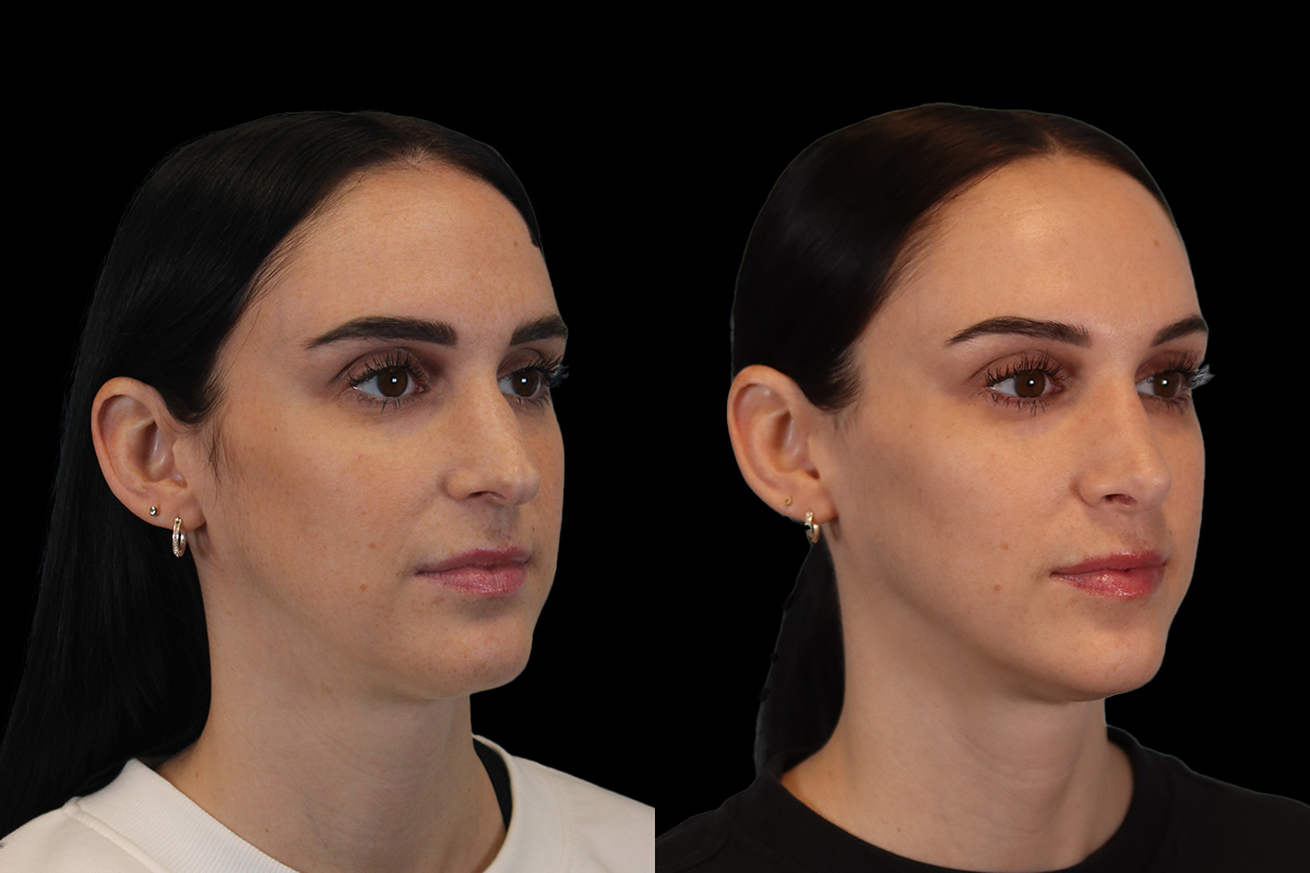 Nose Before & After Gallery - Patient 785538 - Image 3