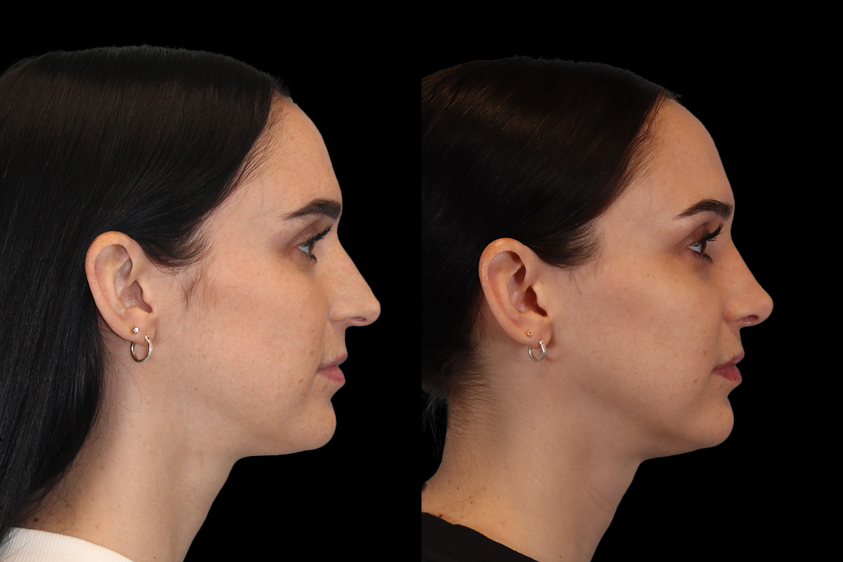 Nose Before & After Gallery - Patient 785538 - Image 5
