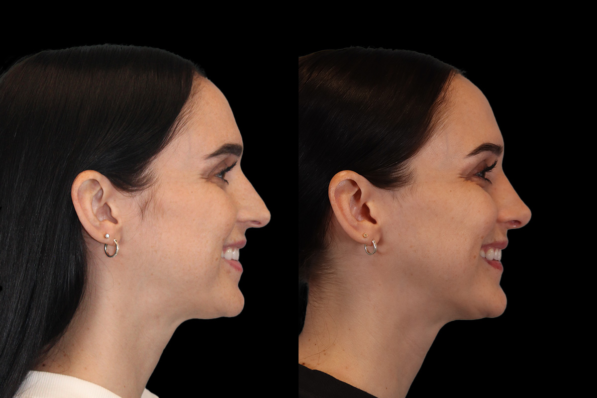 Nose Before & After Gallery - Patient 785538 - Image 6
