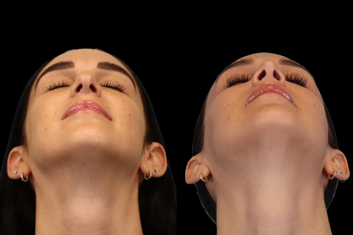 Nose Before & After Gallery - Patient 785538 - Image 10