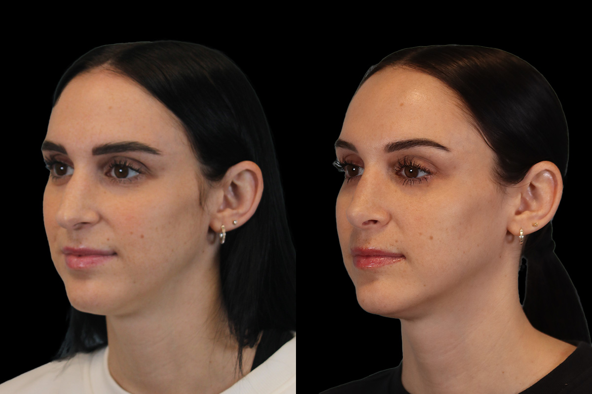 Nose Before & After Gallery - Patient 785538 - Image 7