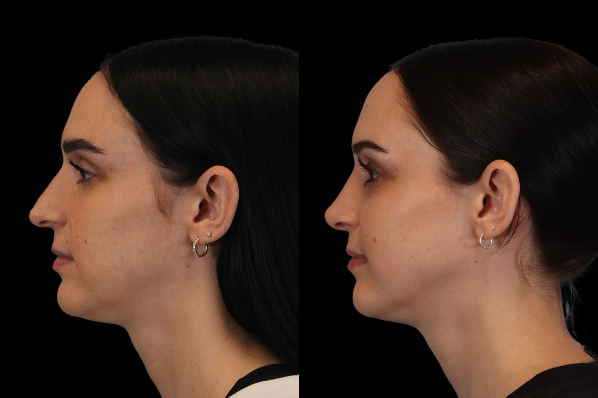 Nose Before & After Gallery - Patient 785538 - Image 8